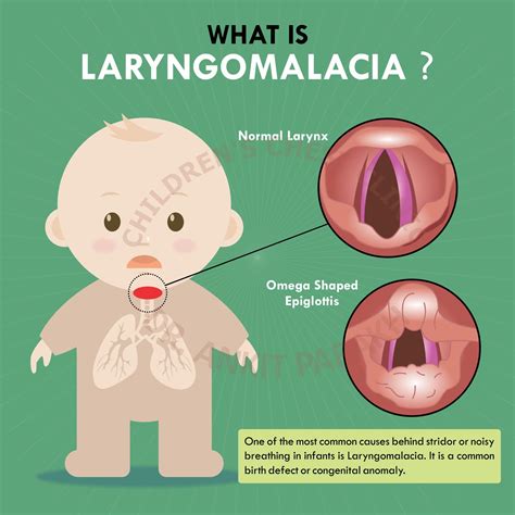 omega sign laryngomalacia.